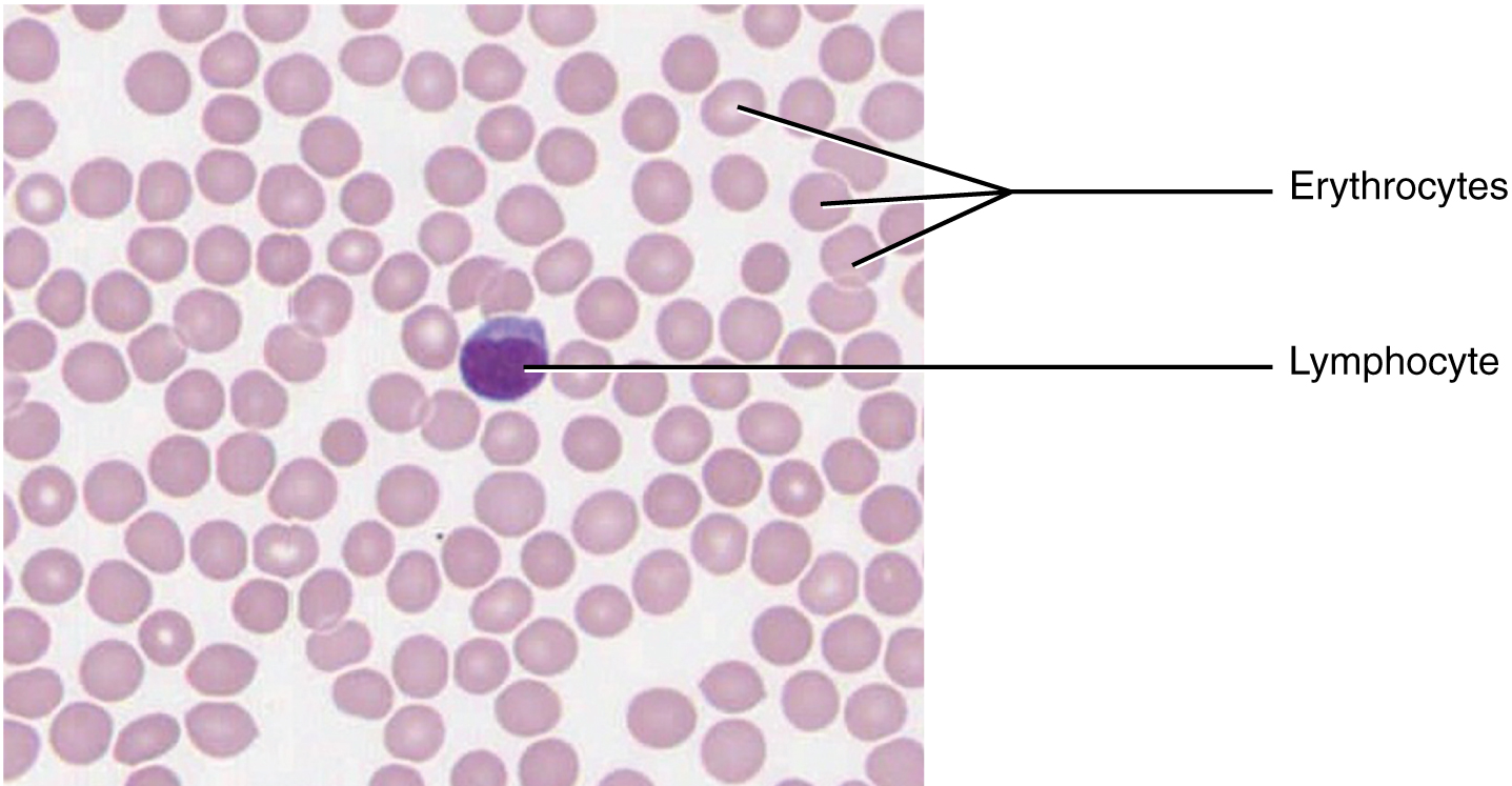 This micrograph of a blood smear shows a group of red blood cells and a single white blood cell. The red cells are small discs which have a slight depression at their centers with no nuclei present. The white blood cell is larger and more darkly stained and has a large, prominent nucleus that is also darkly stained.