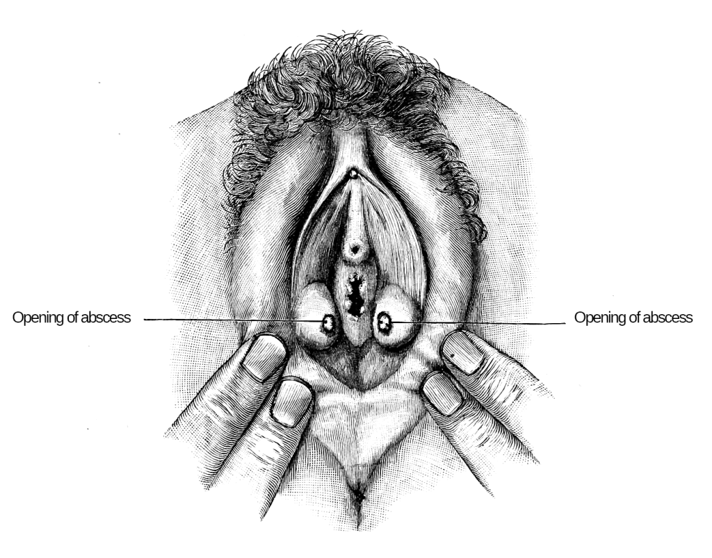 Illustration showing location of a Bartholin's cyst.