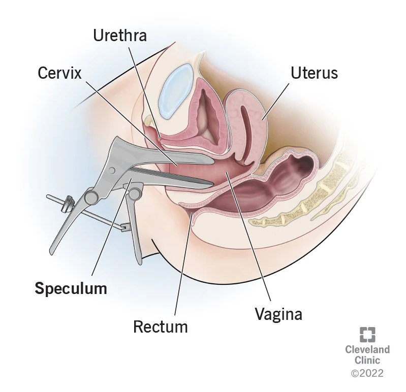 Diagram of speculum inserted into the cervix
