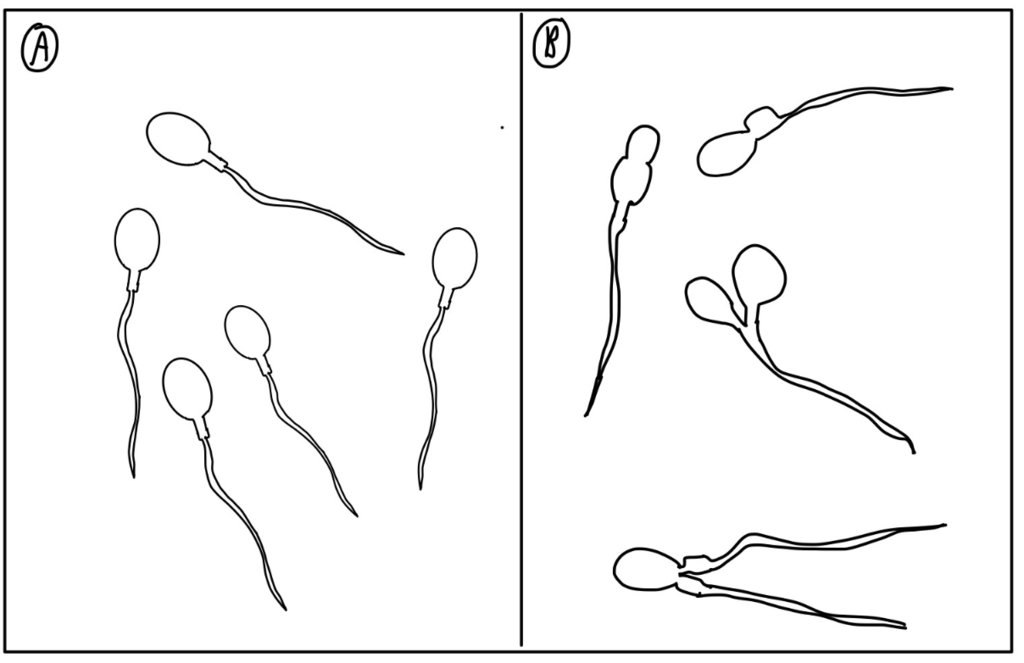 Simple line drawing of sperms in two groups: A are typical with single round heads and long tails. B are atypical with multiple or deformed heads.
