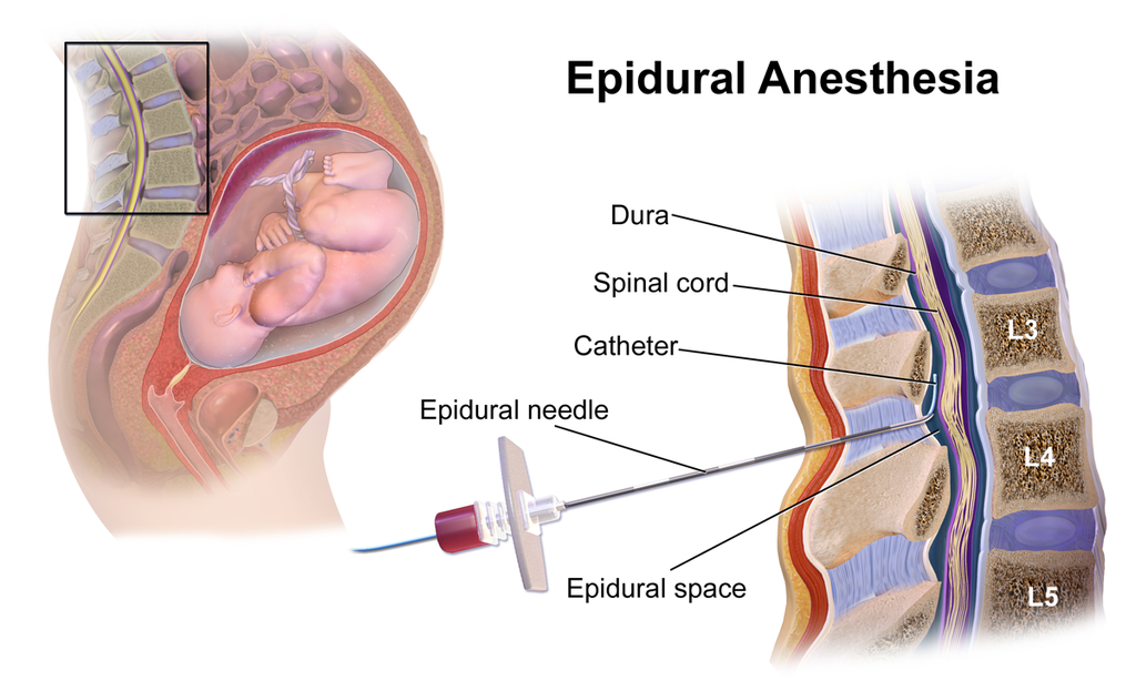 A graphic showing an epidural needle being injected into the spinal cord for anesthesia.