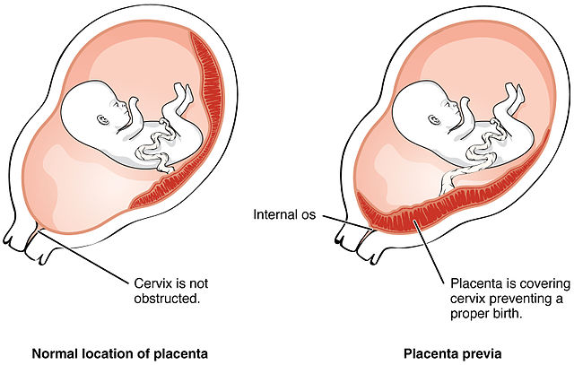 Diagram of placenta placement, the first a normal placement and the second covering the cervix (placenta previa).