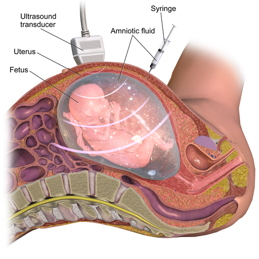 Graphic of a syringe being inserted into amniotic fluid while an ultrasound reviews placement of a fetus.