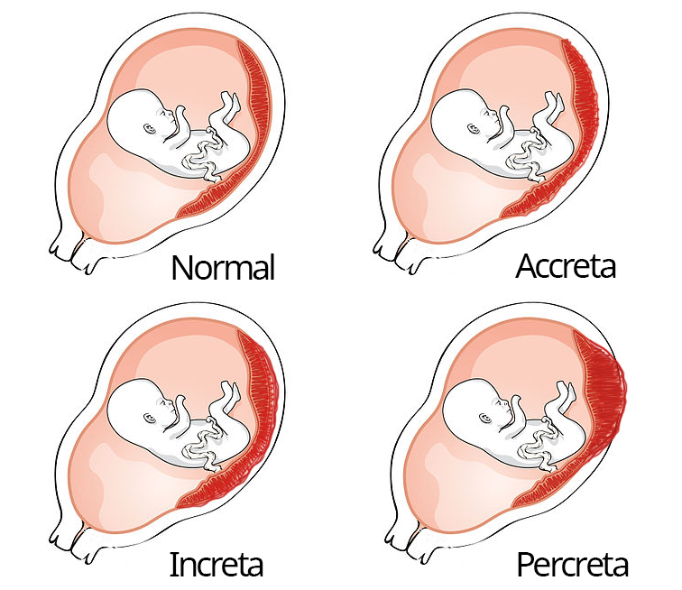 a four-part diagram of placenta growth, including normal growtn, accreta (overgrown), increta (overgrown further into the wall), and percreta (overgrown past the wall).