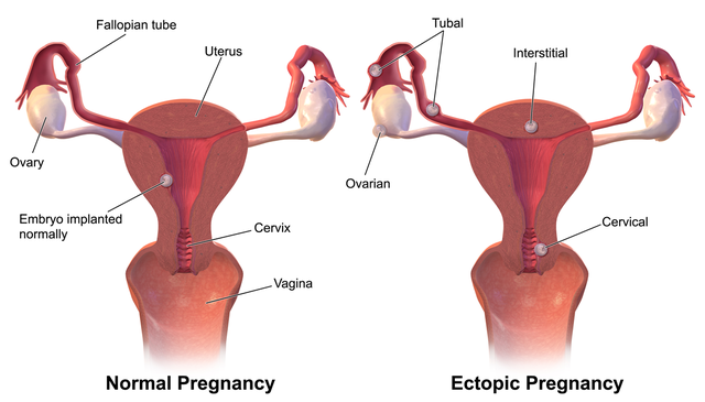 Figure showing two images: a normal pregnancy, and an ectopic pregnancy. In the latter, the embryo is implanted in the fallopian tube, cervix, or too deeply.