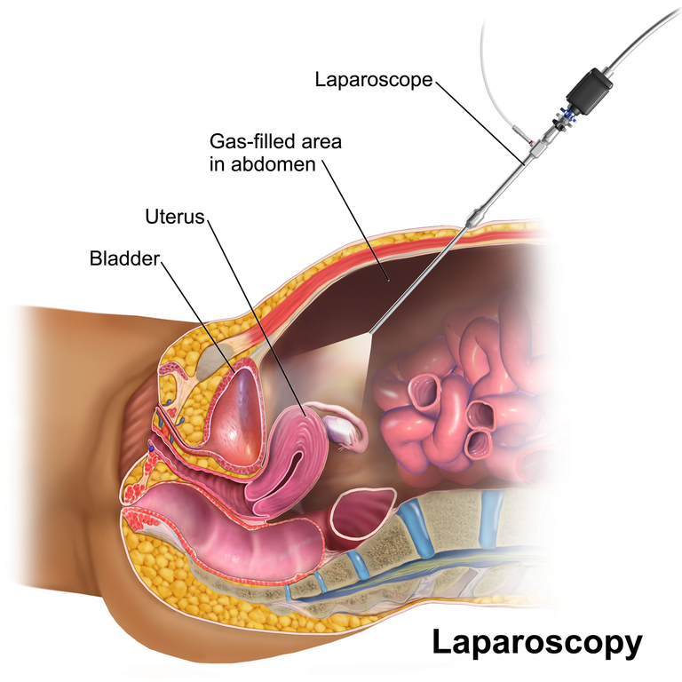 Graphic showing a laparascope with light inserted into the abdomen to examine the uterus and bladder.