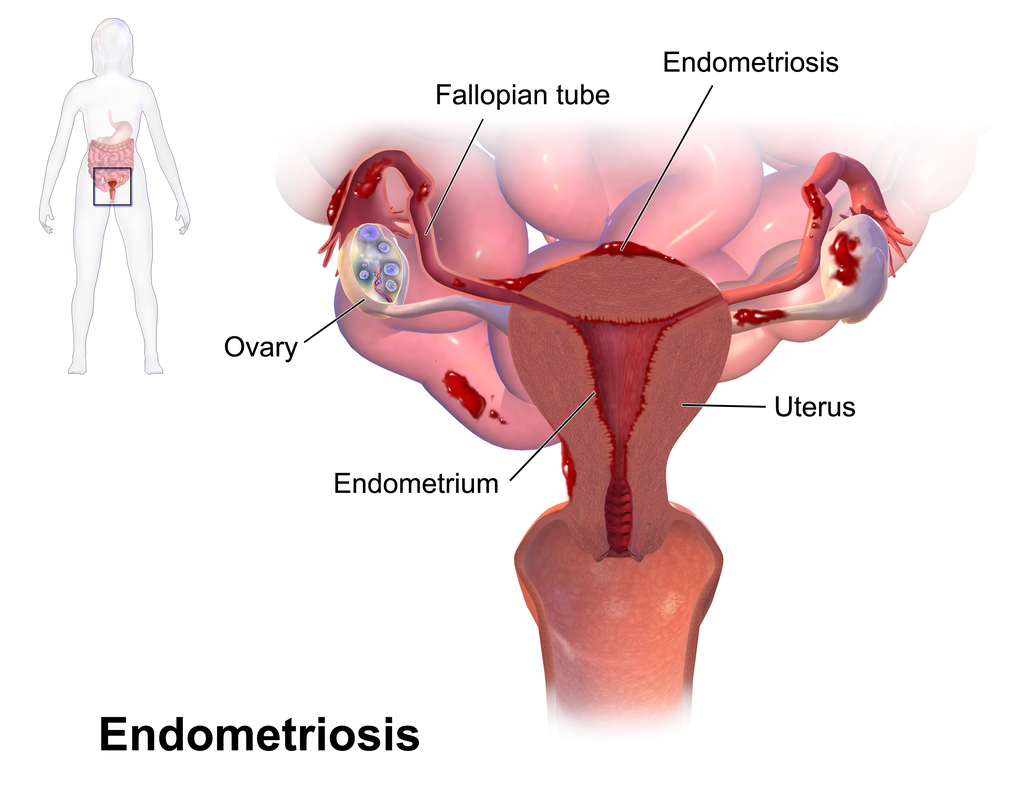 Figure showing the growth of the endometrium outside of its usual bounds, onto the ovaries and fallopian tubes.