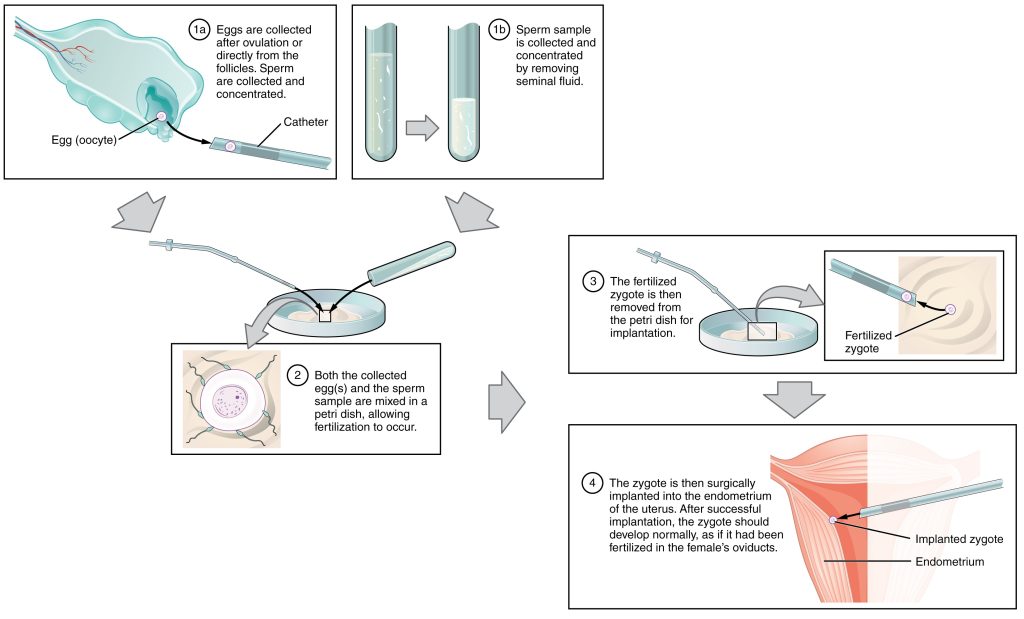 This multi-part figure shows the different steps in in vitro fertilization. The top panel shows how the oocytes and the sperm are collected and prepared. The next panel shows the sperm and oocytes being mixed in a petri dish. The panel below that shows the fertilized zygote being prepared for implantation. The last panel shows the fertilized zygote being implanted into the uterus.