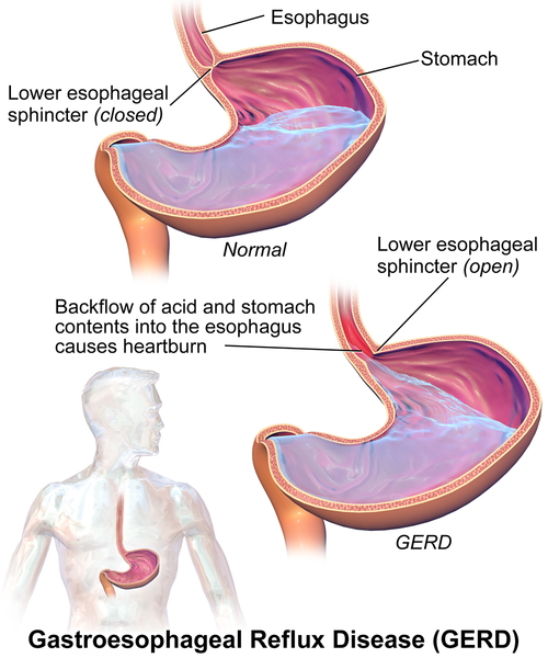 A figure showing how GERD works, with acid backflowing into the esophagus from the stomach, causing heartburn.