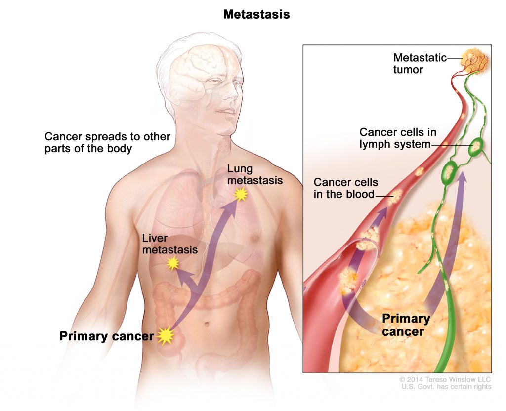 A figure representing metastasis of cancer, spreading across the body from the lower abdomen to the liver and lungs through the lymph system.