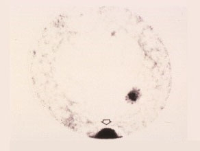 Second Prophase
